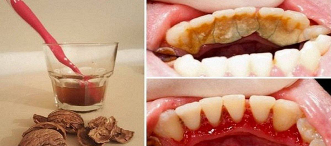 How to Remove Tartar